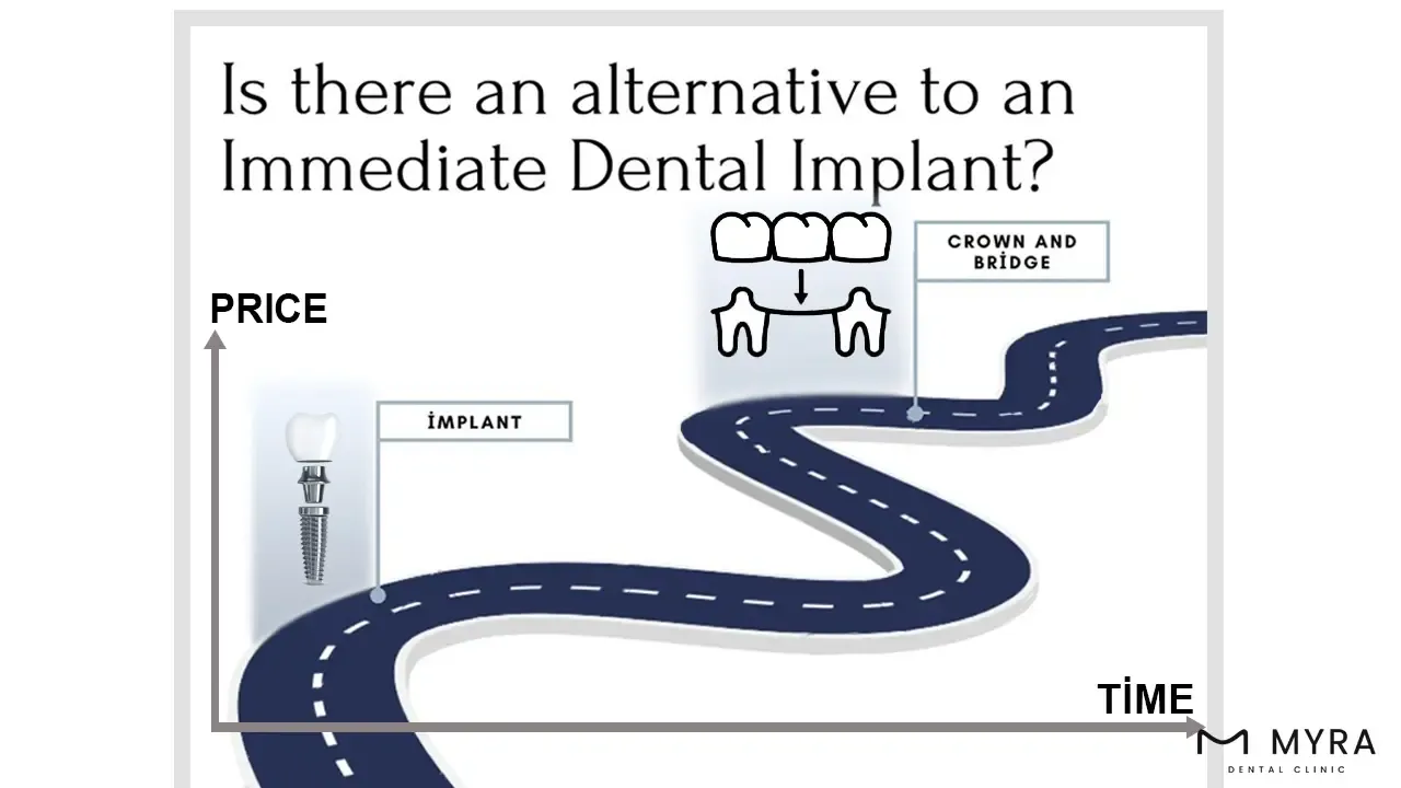 Is there an alternative to an Immediate Dental Implant_.webp